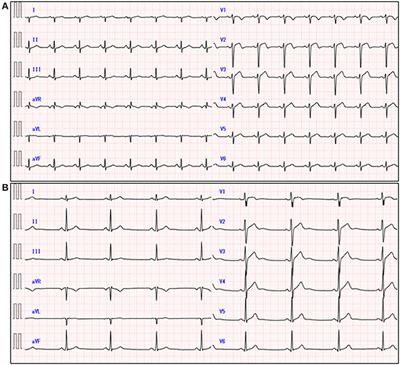 Case Report: Acute Eosinophilic Myocarditis With a Low-Flow Heart Failure With Preserved Ejection Fraction Phenotype